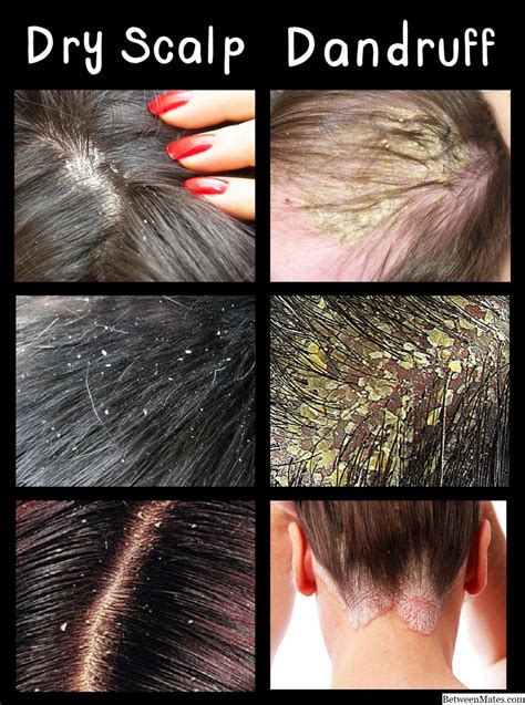 What Is Dandruff Hair Care